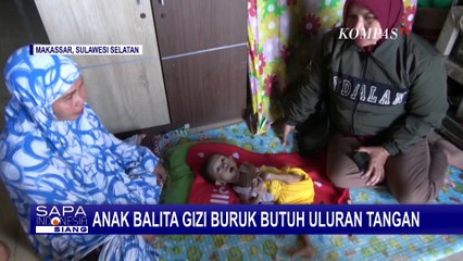 Kisah Raihan, Balita 3 Tahun di Makassar Alami Gizi Buruk Butuh Uluran Tangan