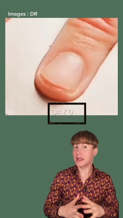 La vitesse de pousse des ongles 