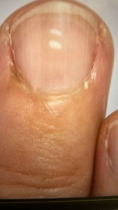 Ces quoi ces petites taches blanches sur les ongles ?