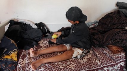 بسبب الحرب.. محمود وزياد طفلان فلسطينيان يعيشان آلاماً جسدية ونفسية حادة