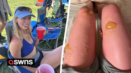 "My legs looked like something alien after extreme sunburn"