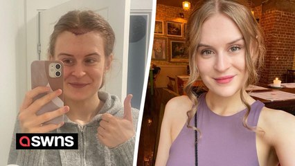 Identical twin has two hair transplants so hairline matches sister's - and it cost £5.5k