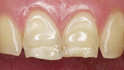 bd-erosion-dental-que-es-y-como-tratarla-110124