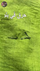See, fabric burns have become very easy to repair.