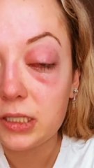 Elle a commencé a devenir aveugle