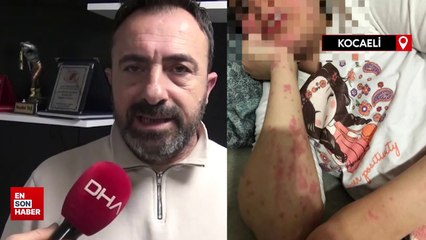 Kocaeli'de hasta kızına verilen ilaç, alerjiye neden oldu