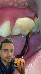 Le DETARTRAGE dentaire : explications