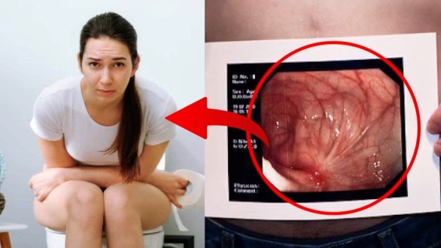 क्रोहन रोग कैसे ठीक करें | Crohn Disease Treatment Symptoms In Hindi | Boldsky