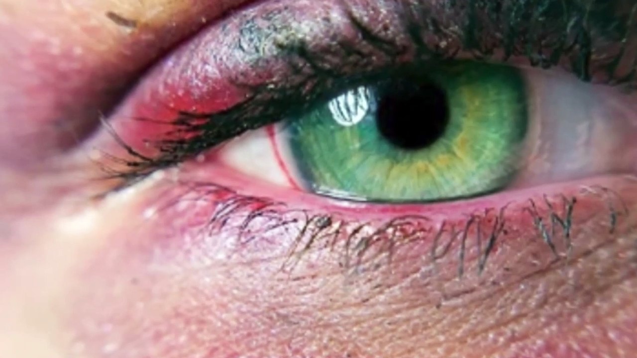 Natural Remedies to Get Rid of Dark Circles Under the Eyes - Effective Tips and Causes