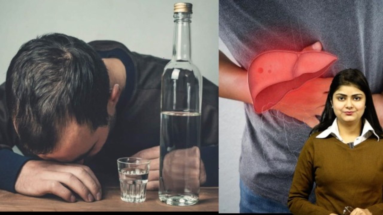 Alcoholic Hepatitis Kya HaiAlcoholic Hepatitis Symptoms, Treatment In