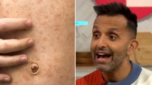 Doctor shares measles signs and symptoms to look out for as UK cases surge