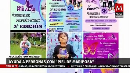 Son mis alas': asociación para concientizar sobre la piel de mariposa