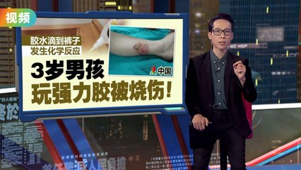 3岁男孩玩强力胶意外烧伤，裤子发生化学反应引发火灾🔥