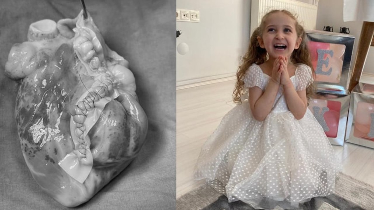 Bu bir tıp mucizesi: Minik kalbini 'söküp' tümörü temizleyip tekrar yerleştirdiler Bu bir tıp mucizesi: Minik kalbini 'söküp' tümörü temizleyip tekrar yerleştirdiler