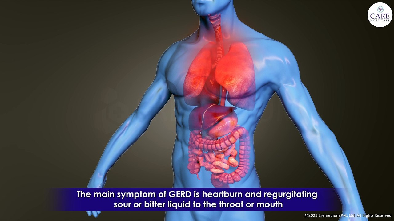GERD - Gastroesophageal Reflux Disease, GERD Causes, Symptoms, Treatment