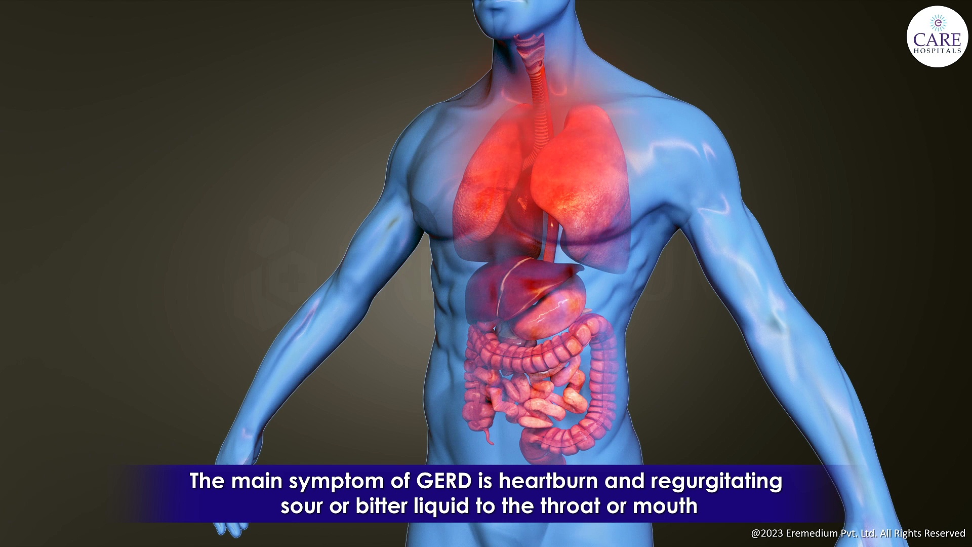 GERD - Gastroesophageal Reflux Disease, GERD Causes, Symptoms, Treatment