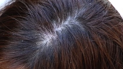 Dandruff: Here's the lesser known reason it happens