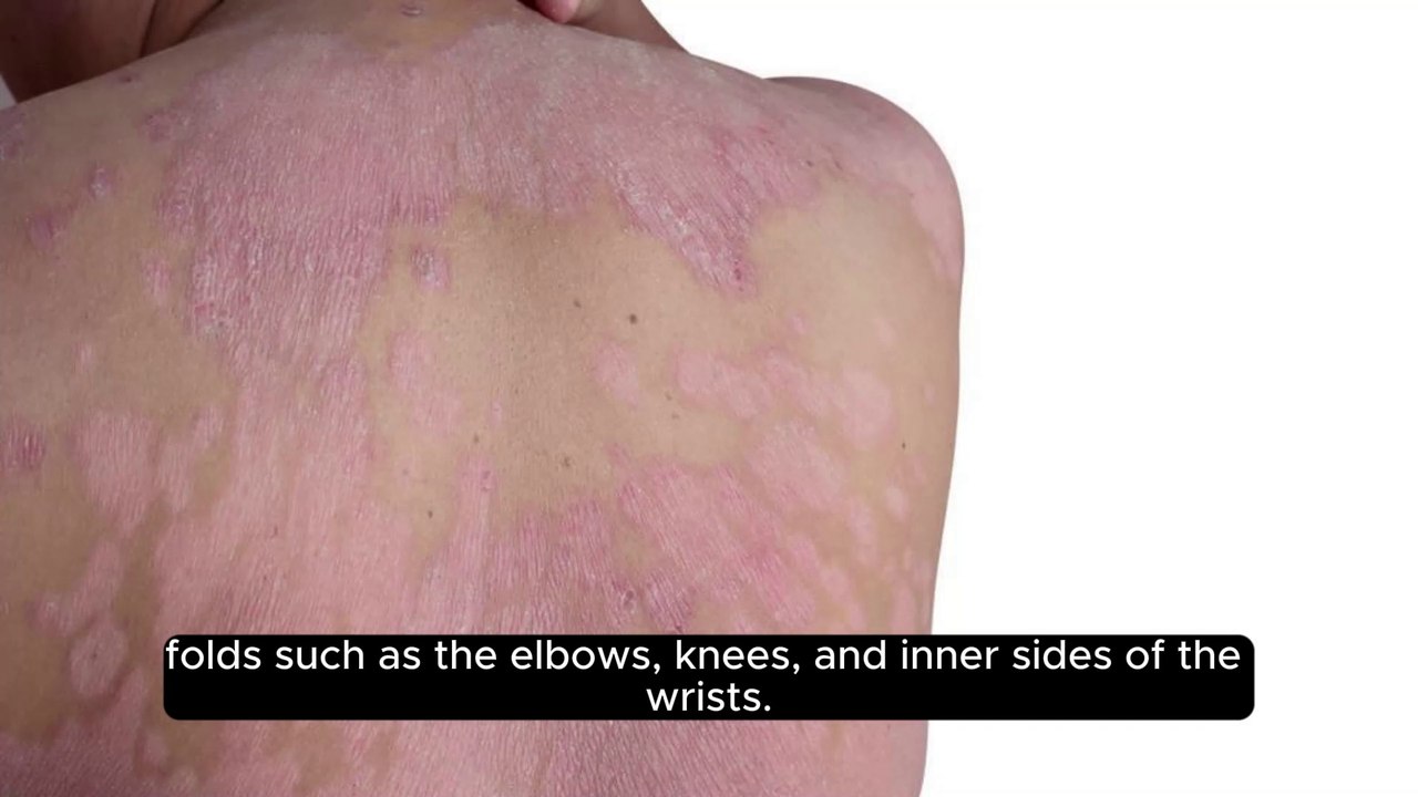 Psoriasis