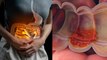 आंत में सूजन का इलाज | Ulcerative Colitis Symptoms & Treatment In Hindi | Boldsky