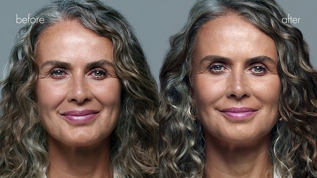 Before and After Dermal Fillers