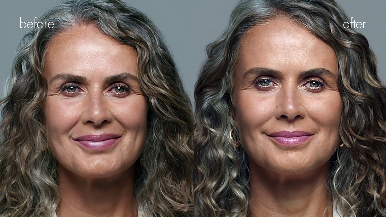 Before and After Dermal Fillers