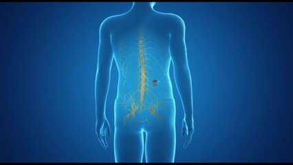 Dolore cronico, il dispositivo che lo combatte 50 volte al secondo (Medtr