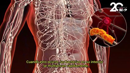 ¿Qué es la apendicitis y cómo se desarrolla? 🩺