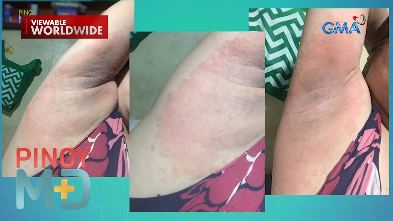 Kilikili ng isang babaeng gumamit ng whitening product, nangitim at nagsugat?! | Pinoy MD