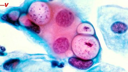 The U.S. Is Currently Experiencing an STI Epidemic