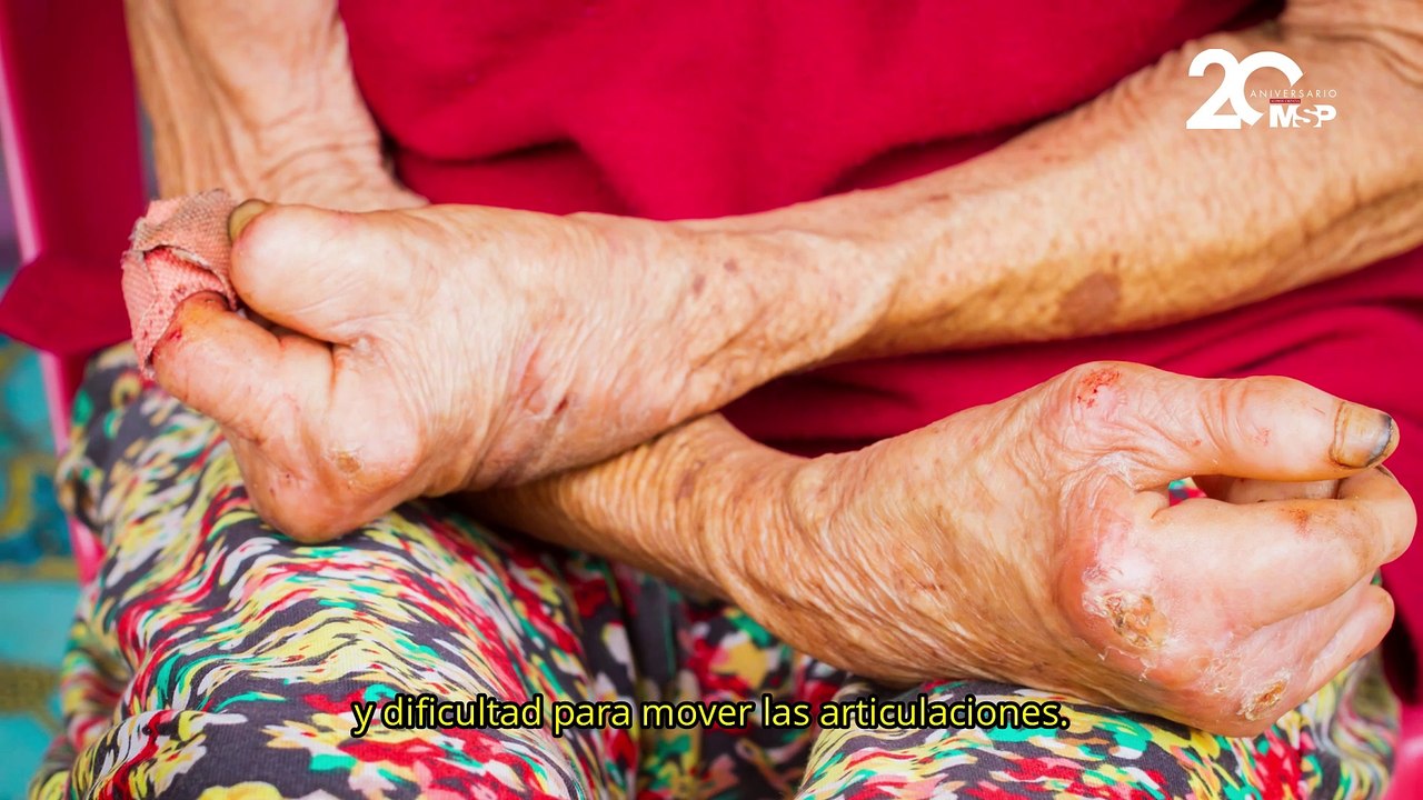 Día mundial contra la Lepra: ¿Cómo se transmite, diagnostica y trata? - #ExclusivoMSP