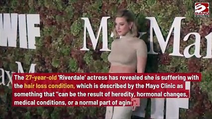 Lili Reinhart Gets Real About Her Hair Loss Diagnosis.