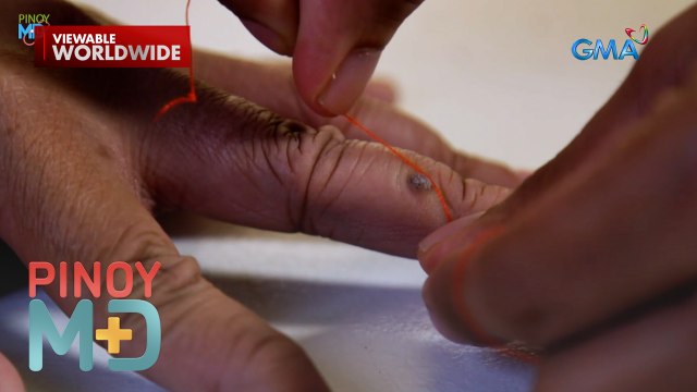 Nauusong instant kulugo remover, ligtas nga ba? | Pinoy MD