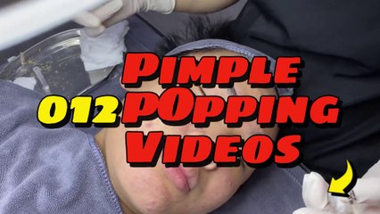 Satisfying Pimple Popping Videos 012
