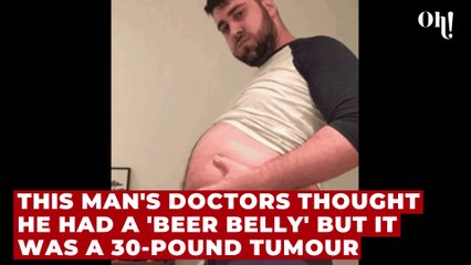 This man's doctors thought he had a 'beer belly' but he actually had a 30-pound tumour