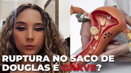O que é SACO de DOUGLAS: entenda ruptura que causou morte de jovem