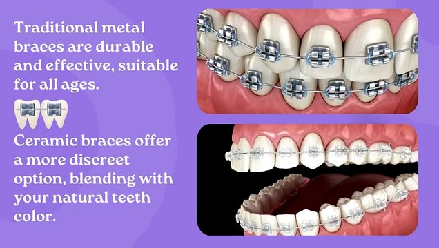 Smile Makeover Journey: Finding Your Perfect Braces!