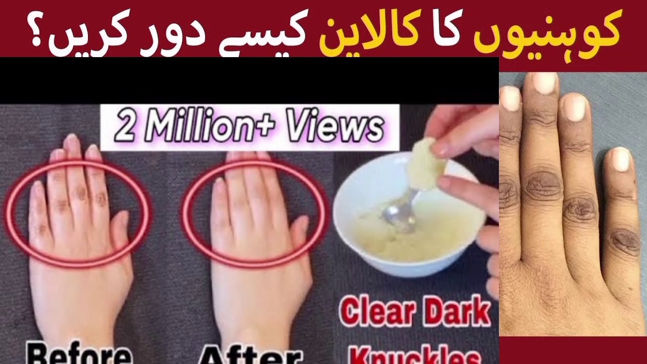 Lighten Dark Knuckles Naturally with  Home Remedies, Learn how to get Whiten, Knees, Elbow, Ankle Tips,