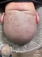 Thinning Crown Restoration