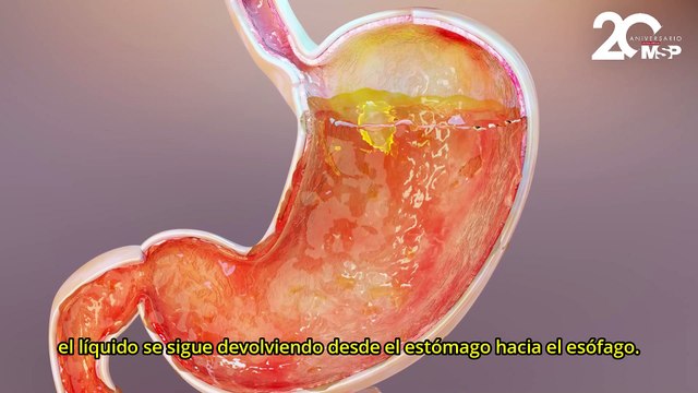 Funduplicatura transoral sin incisión: una opción innovadora para el reflujo gastroesofágico - #MSP