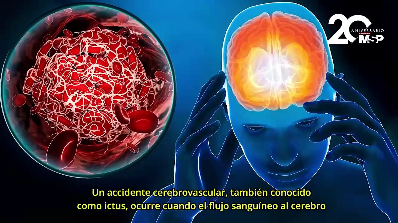¿Qué puede provocar un accidente cerebrovascular o ictus? - #ExclusivoMSP