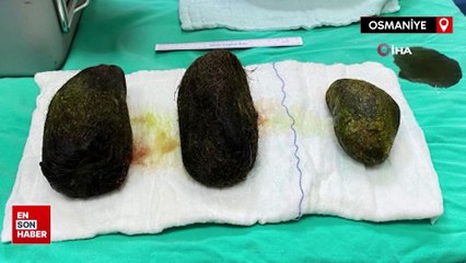 Osmaniye'de karın ağrısı yaşayan kadının midesinden saç çıktı