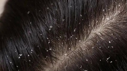 bd-manejo-adecuado-y-efectivo-para-despedirse-de-la-caspa-160224