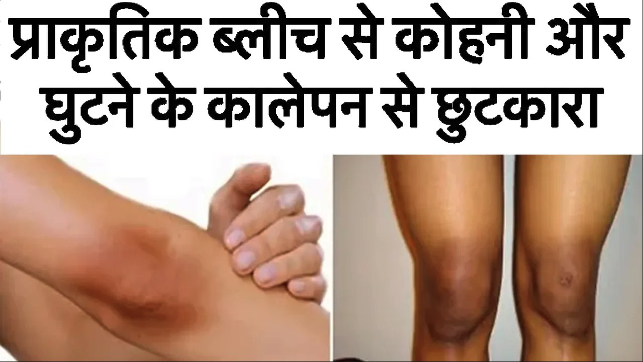 प्राकृतिक ब्लीच से कोहनी और घुटने के कालेपन से छुटकारा | Whiten Your Dark Elbows & Knees Naturally
