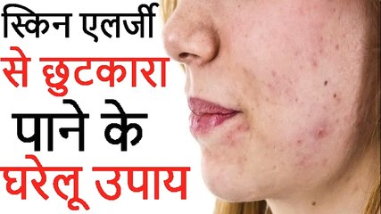 स्किन एलर्जी से छुटकारा पाने के घरेलू उपाय | Skin Allergy Treatment And Diagnosis