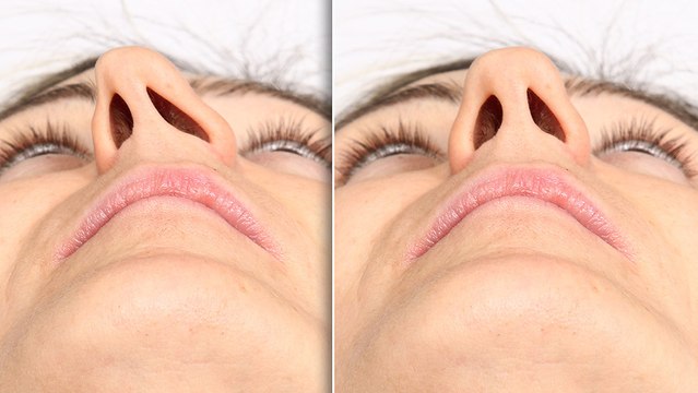 bd-complicaciones-del-tabique-nasal-desviado-210224