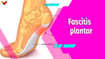 Buena Vibra  | Causas y tratamientos de la fascitis plantar