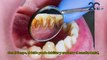 ¿Qué son las caries dentales y por qué tratarlas es vital? - #ExclusivoMSP