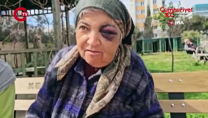 Diyaliz merkezinde skandal iddia: Engelli kadının yüzü tanınmaz hale geldi