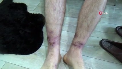 Yaş beton neden oldu! Temas etmesinin ardından vücudunda yanıklar oluştu