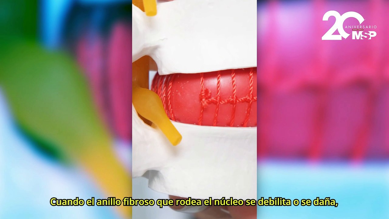¿Cómo se forma una hernia discal y qué tratamientos existen? - #EspecialMSP